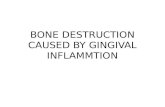 Bone Destruction Caused by Gingival Inflammtion