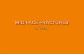 mid face fracture
