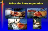 Below the Knee Amputation