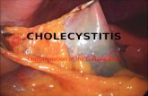cholelithiasis GRAND CASE PRES