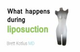 What happens during liposuction surgery by Brett Kotlus MD