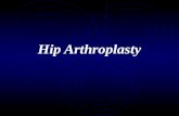 Hip Arthroplasty. Anatomy of Hip Hip Joint Ball and socket Ball is the femoral head Socket is Acetabulum Half sphere depression Lined with cartilage.