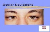 ocular Deviations
