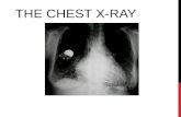 Chest x ray