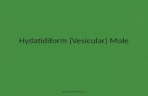 Hydatidiform (vesicular) mole