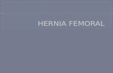 Hernia femoral
