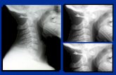 Cervical Spine Injury | C Spine | Clearing the Cervical Spine
