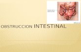 Obstruccion intestinal (1)