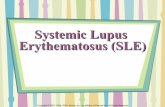 Systemic Lupus Eritematosus