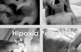 Hipoxia perinatal