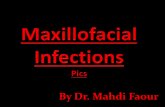 Maxillofacial infections