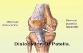 patellar dislocation