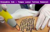 Tampa Laser Tattoo Removal