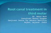 Root canal treatment in third molar