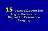 15 cerebellopontine angle masses on magnetic resonance imaging
