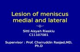 Lesion of Meniscus Medial and Lateral