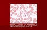 02. Anemia Sideroblastica Congenita