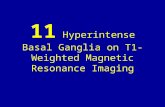 11 hyperintense basal ganglia on t1 weighted magnetic resonance