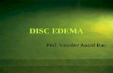 DISC EDEMA Prof. Vasudev Anand Rao. CAUSES UNILATERAL Papillitis Anterior Ischemic optic neuropathy Neuroretinitis Papillophlebitis Ischemic CRVO Anterior.