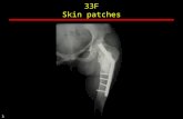 33F Skin patches 3. 2 1 McCune Albright 13M Bone Age - ESRD 2.