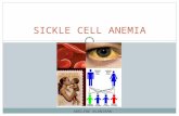 ADELINE OLANIRAN SICKLE CELL ANEMIA. What is Sickle Cell Anemia? A serious condition in which red blood cells can become sickle-shaped Normal red blood.