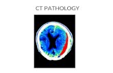 CT PATHOLOGY. Subdural Hematoma Subdural hematomas are usually the result of a serious head injury. When one occurs in this way, it is called an "acute"