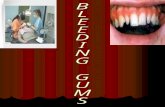 Bleeding gums Bleeding gums More than 80% of adults have some form of periodontal disease and 99% of those have no signs to indicate they have a problem.