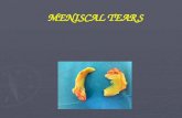 MENISCAL TEARS. MENISCOS Fibrocarilage Semilunar Internal: C External: O MENISCI Parallel colagen fibers Radial (sup/inf) Circunferencial Perforans.
