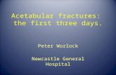 Acetabular fractures: the first three days. Peter Worlock Newcastle General Hospital.