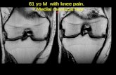 61 yo M with knee pain. Medial meniscal tear.