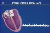Atrial fibrillation wavelets propagating in different directions disorganised atrial depolarisation without effective atrial contraction f waves 350-600.
