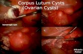 Corpus Lutum Cysts (Ovarian Cysts) Mikaela Potter.