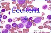 Leukemia Jeff Liu, Period 5. What Is Leukemia? Cancer of the white blood cells Acute or Chronic Affects ability to produce normal blood cells Bone marrow.