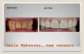 Smile Makeover….new veneers BEFORE AFTER. Smile Makeover….new crowns BEFOREAFTER.