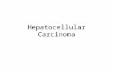Hepatocellular Carcinoma. Epidemiology 5 th most common cancer in men and the eighth most common cancer in women worldwide Incidence rate equals death.