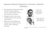 Leprosy (Hansen Disease) is a chronic, systemic infection. Mycobacterium leprae infects the skin and peripheral nerves, deformities due to lack of pain.