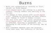 Burns Burns are categorized by severity as first, second, or third degree. First degree burns are similar to a painful sunburn, causing redness and swelling.