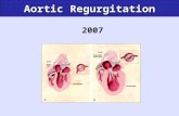 2007 Aortic Regurgitation. Definition Failure of aortic leaflet cooptation in diastole Chronic Aortic Regurgitation.