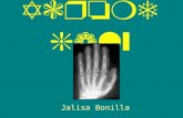 Acromegaly Jalisa Bonilla. Description A hormonal disorder that results from too much growth hormone (GH) in the body. The pituitary gland is what makes.