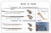 1 Fixion ™ IM (Intramedullary) Nail Fixion ™ IL (Interlocking) Nail DISC O TECH.