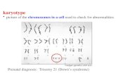 Prenatal diagnosis: Trisomy 21 (Down’s syndrome) karyotype picture of the chromosomes in a cell used to check for abnormalities.