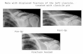 Male with displaced fracture of the left clavicle, treated with clavicle pin Pre-Op Post-Op Fracture healed.