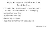 Post Fracture Arthritis of the Acetabulum THA in the treatment of post-traumatic arthritis of acetabulum is challenging --extensive scarring --retained.