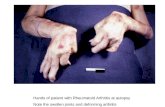 Hands of patient with Rheumatoid Arthritis at autopsy Note the swollen joints and deforming arthritis.