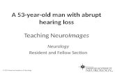 A 53-year-old man with abrupt hearing loss Teaching NeuroImages Neurology Resident and Fellow Section © 2013 American Academy of Neurology.