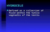 HYDROCELE Defined as a collection of fluid within the tunica vaginalis of the testis Defined as a collection of fluid within the tunica vaginalis of the.