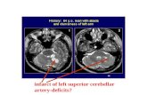 Infarct of left superior cerebellar artery-deficits?