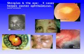Shingles & the eye:  3 cases herpes zoster ophthalmicus, HZO David Kinshuck