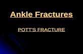 Ankle Fractures POTT’S FRACTURE