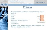 Edema Water retention under the skin which may occur around  eyes; face; limbs;